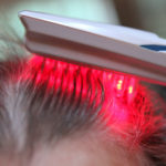 Лазерная терапия волосистой части головы